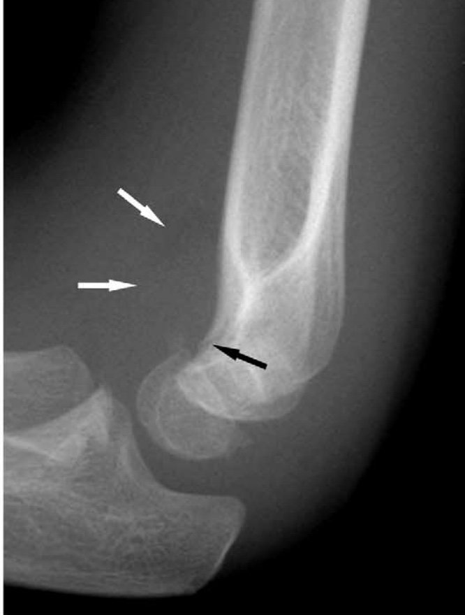 How to screen a paediatric elbow Xray for injuries